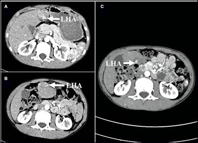 Case report: A case of giant accessory hepatic lobe torsion combined with left hepatic vein branch thrombosis in a child